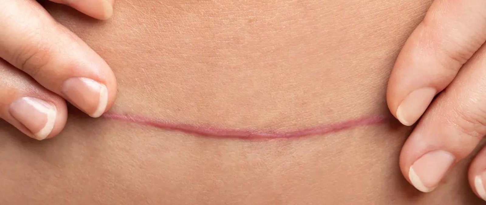 Understanding Best Scar Revision Surgery: Techniques and Benefits