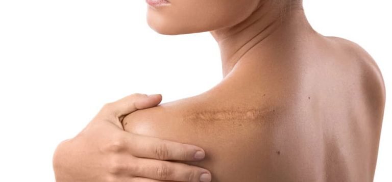 Types of Scars: Which Ones Can Scar Revision Surgery Treat?